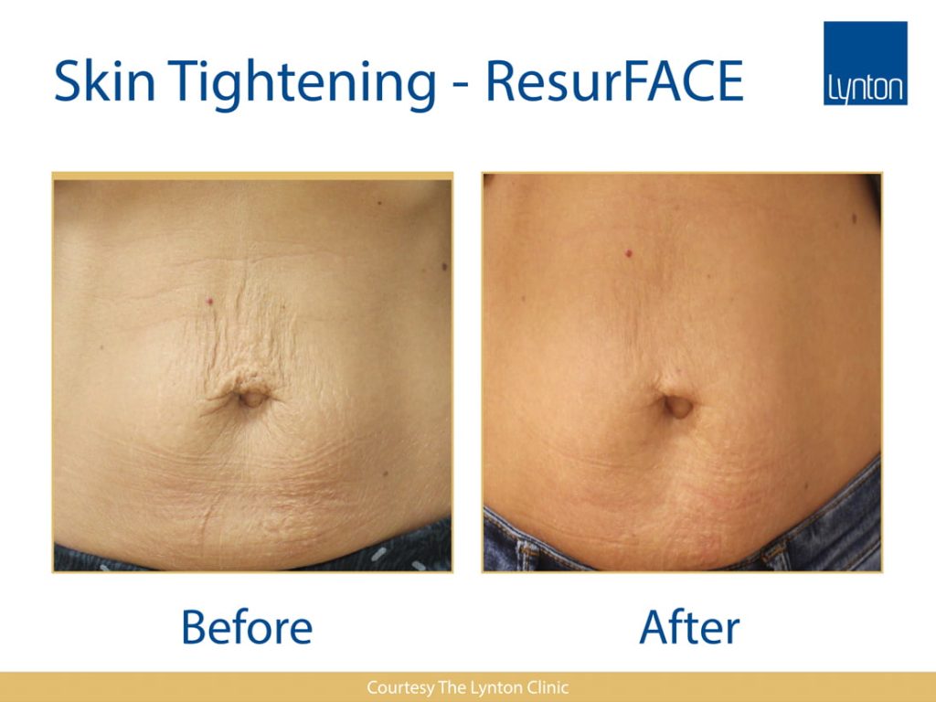 Skin-Tightening by laser