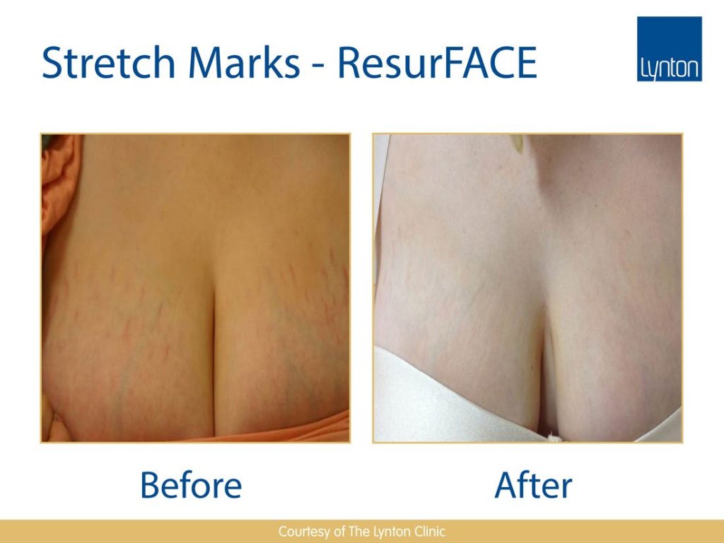 laser removing Stretch-marks