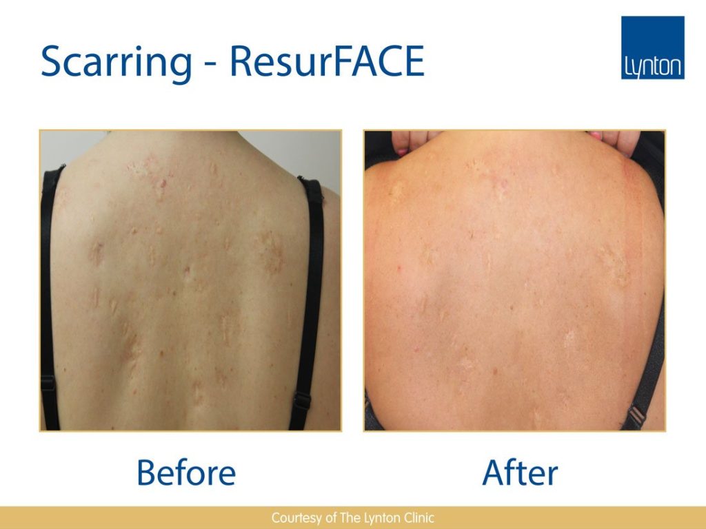 laser skin scarring removal